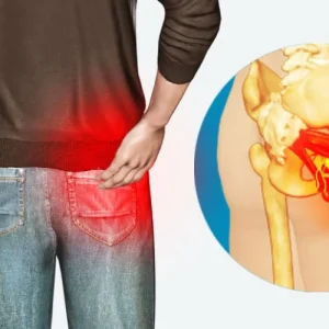 پکیج تمرینات گرفتگی عصب سیاتیک