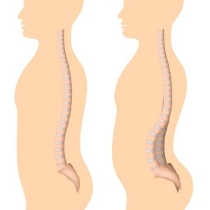 پکیج تمرینات رفع گودی کمر