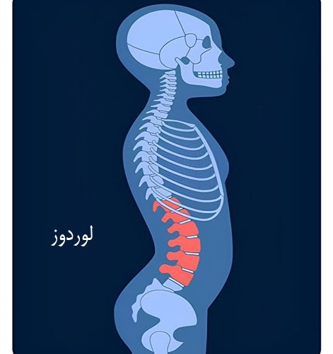 تمرینات کمک به رفع گودی کمر (لوردوز)- سری 2
